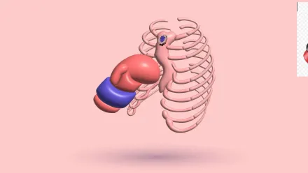 Pectus Excavatum And Contact Sports: Bar Displacement