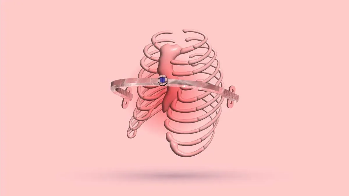 Discomfort With Pectus Nuss Bar: Symptoms, Tips & More