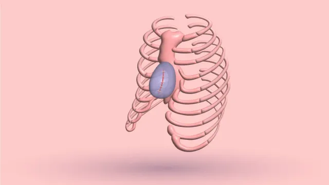 A 3D rib cage with a stitched silicone implant filling the hollow beside the sternum