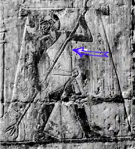 Pectus excavatum ancient egypt relief