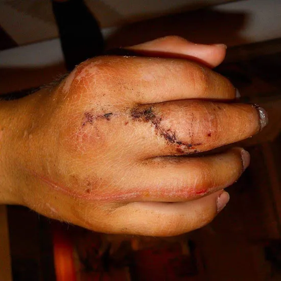 My fracuted finger and bodyfat