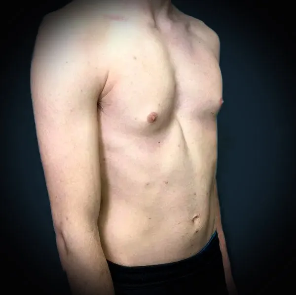 Gynecomastia and sunken chest deformity after surgery