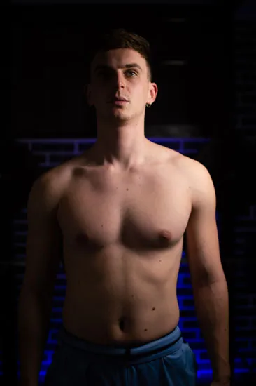 Uneven shoulders pectus 1