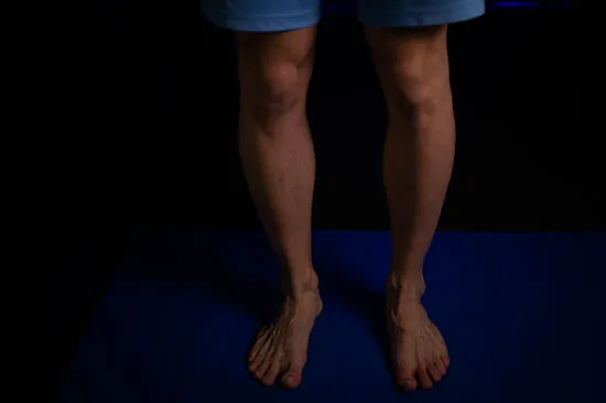 Feet and pectus excavatum connection