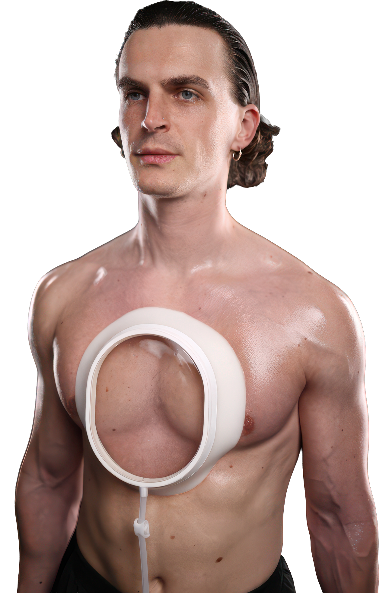 Pectus Excavatum