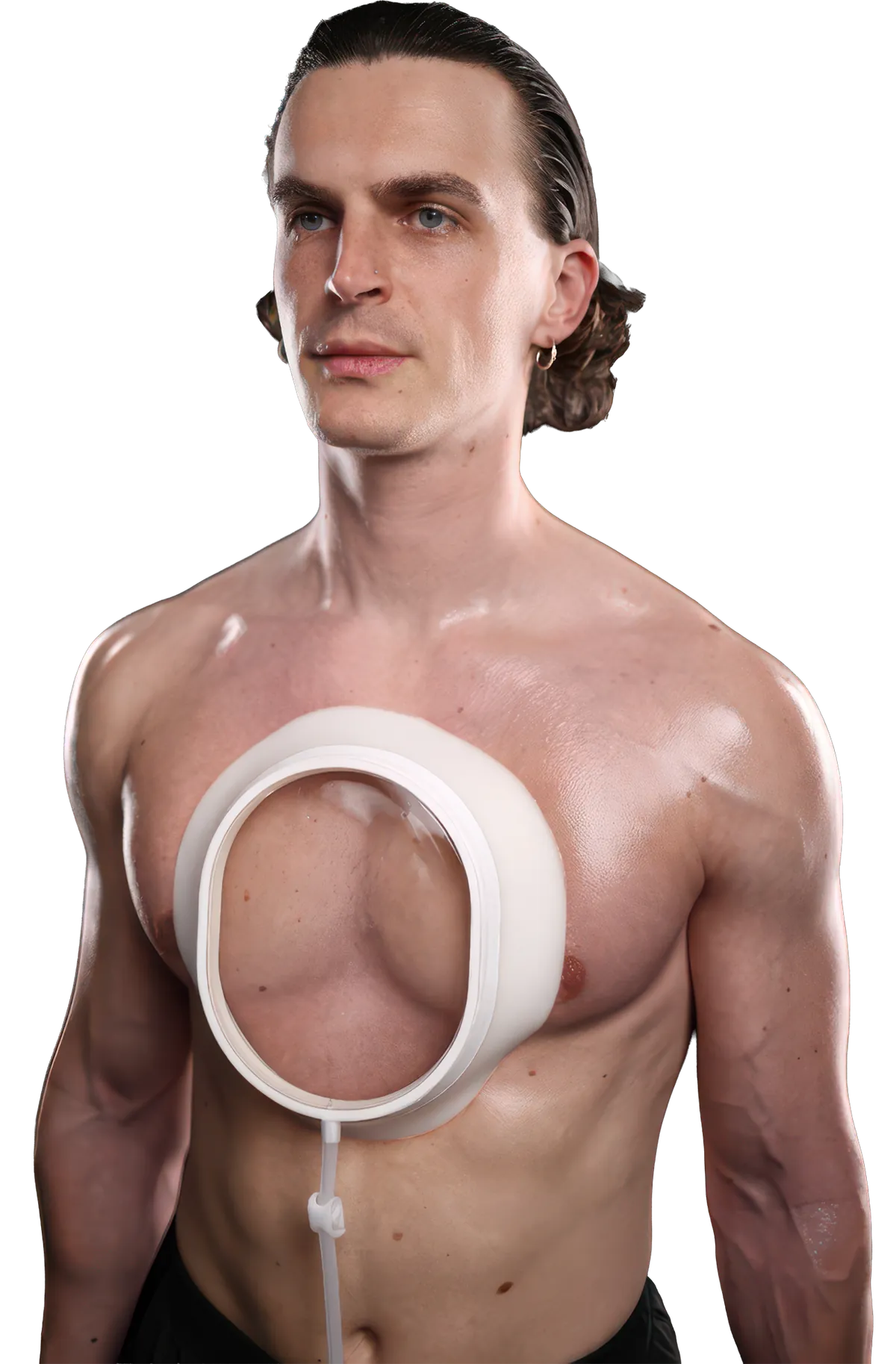 Pectus Excavatum