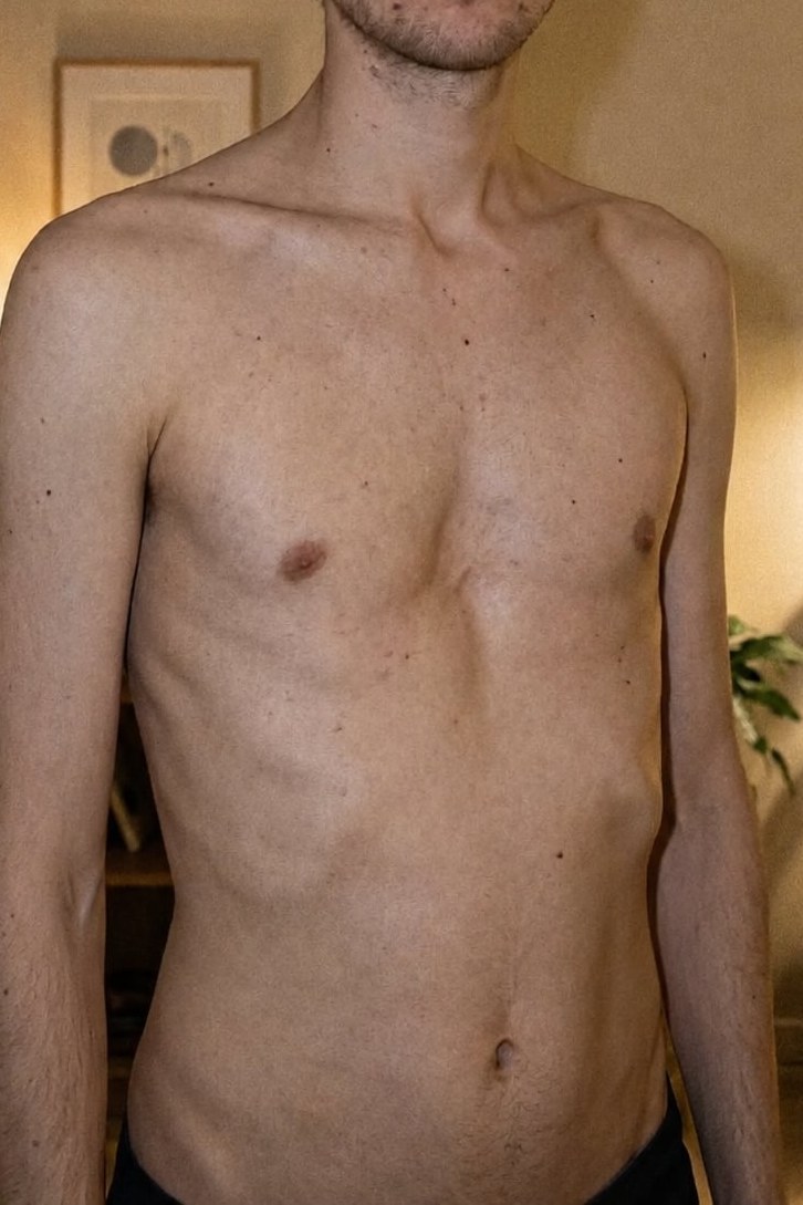 Lars — pectus excavatum and rib flare chest before and after 5 months of exercise and 1-on-1 coaching