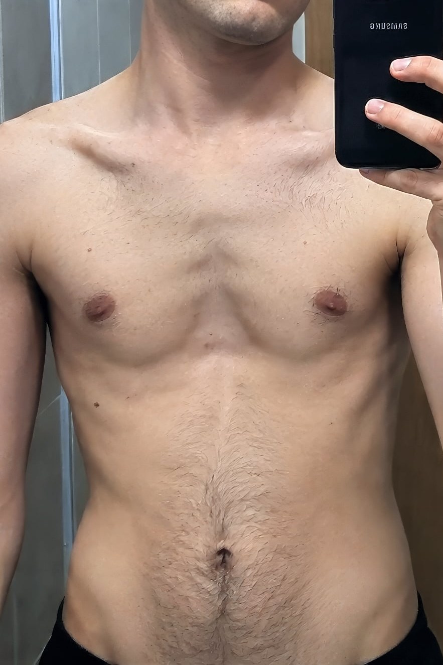 Milo — pectus excavatum chest before and after 2 months on the protocol